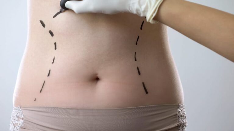 Tummy Tuck Personalized Treatment for Lasting Results