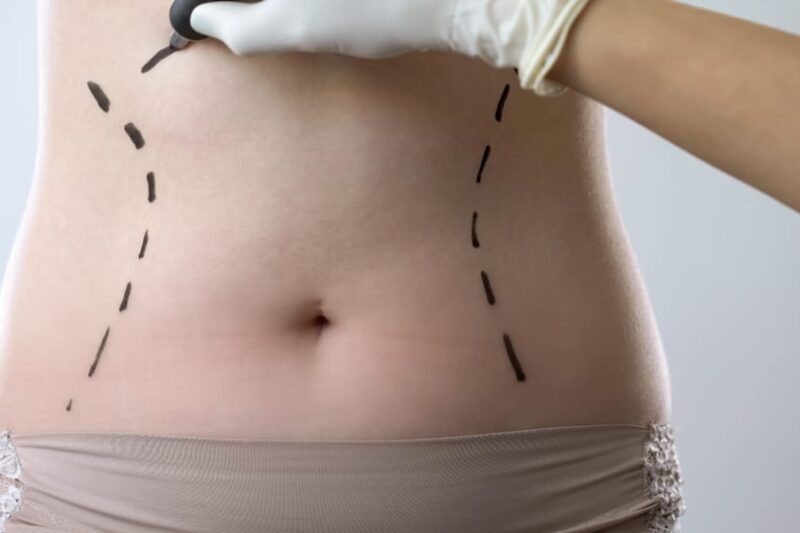 Tummy Tuck Personalized Treatment for Lasting Results