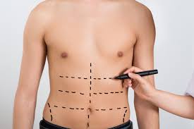 Tummy Tuck in Islamabad2