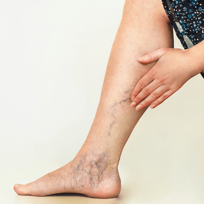 Are Multiple Areas Treatable with Sclerotherapy?