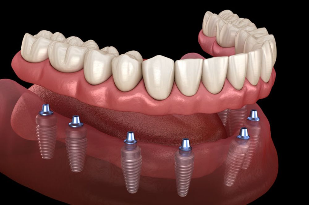 dental implant cost hayward wi