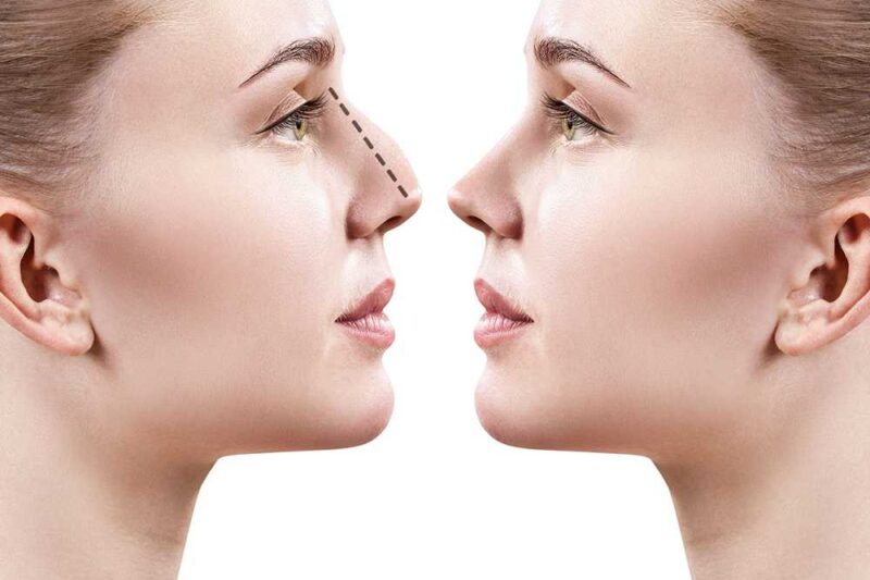 Step-by-Step Procedure of Rhinoplasty in Islamabad