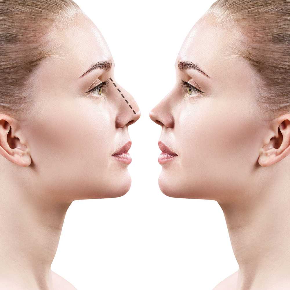 rhinoplasty in islamabad
