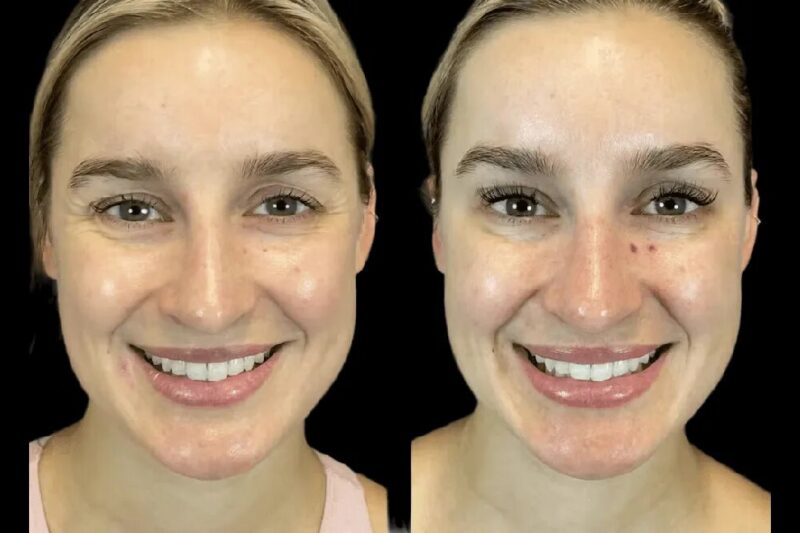 How the Best Plastic Surgeon in dubai Uses Micro-Botox for Skin Rejuvenation