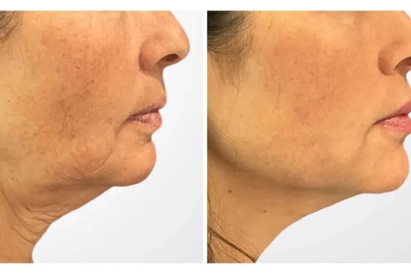 Best Plastic Surgeons in Dubai for Thread Lift Customized Treatment Plans