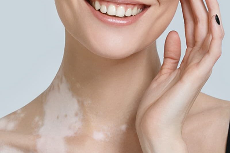 ما الذي يجعل علاج البهاق فعالاً اليوم؟