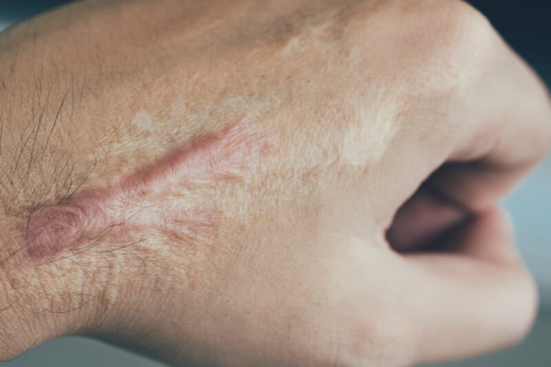 ما هو أفضل علاج للجُدرة للندبات القديمة؟