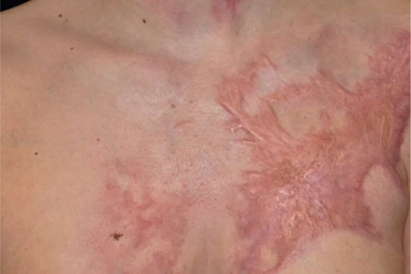 ما هي مخاطر جراحة ترميم الحروق؟