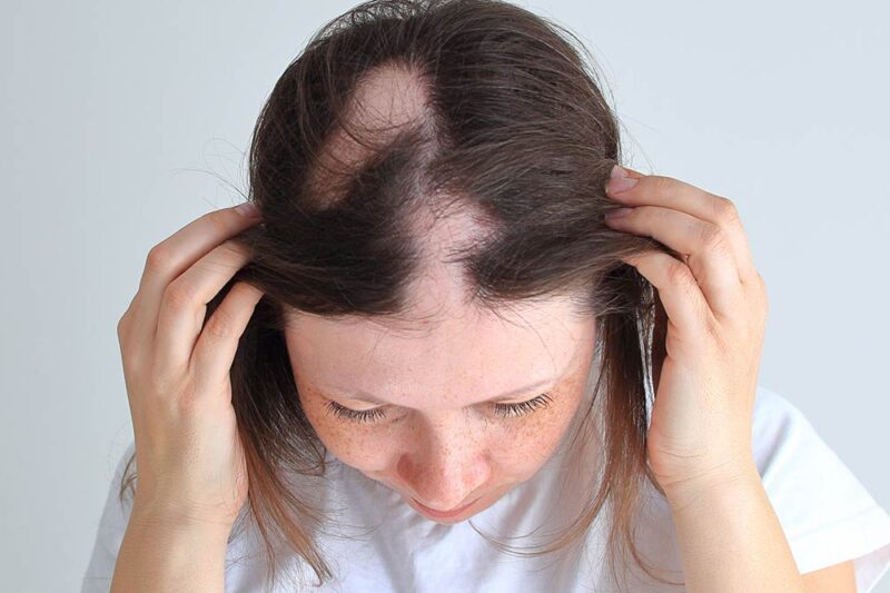 هل يستحق علاج داء الثعلبة التجربة؟