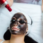 Achieve Flawless Skin with Laser Carbon Peel1