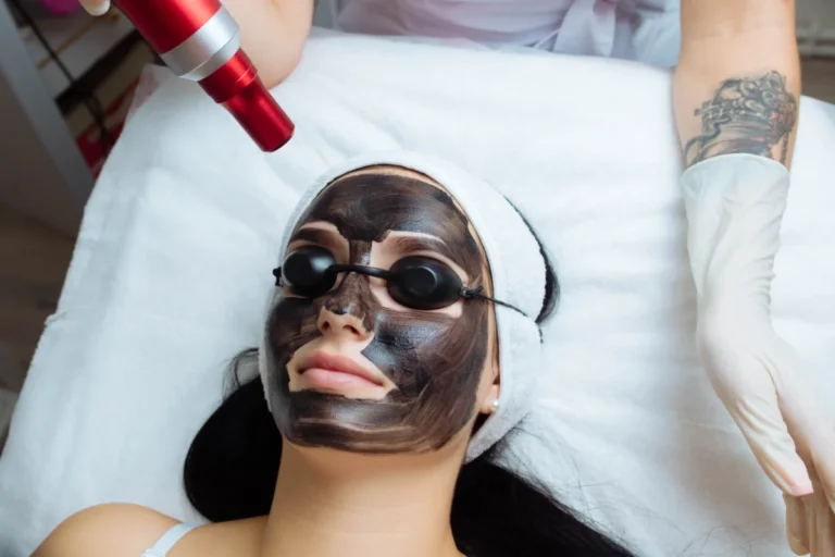 Achieve Flawless Skin with Laser Carbon Peel1
