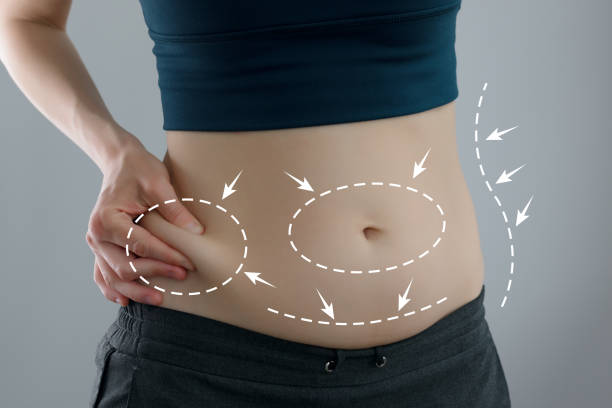 Advanced Fat Removal with Vaser 4D Liposuction