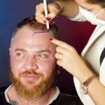 Affordable Hair Transplant Options Explained