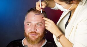 Affordable Hair Transplant Options Explained