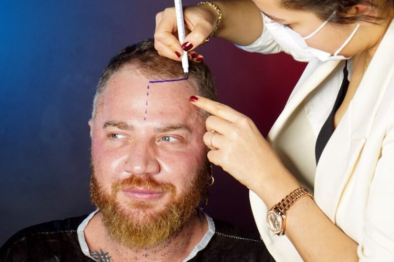 Affordable Hair Transplant Options Explained