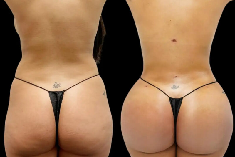 fat transfer in dubai