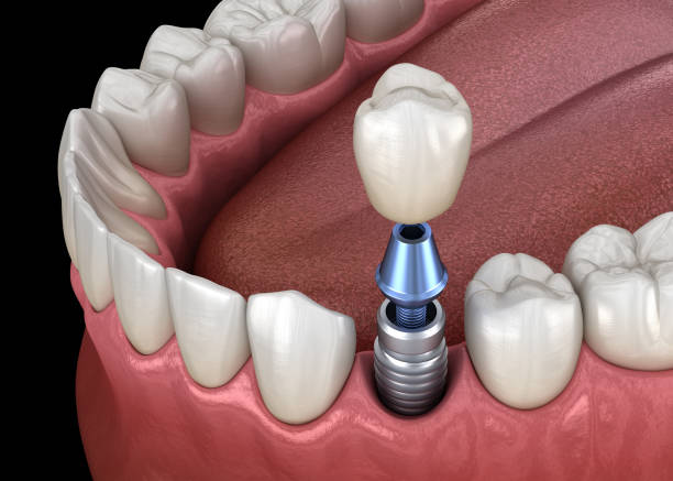 Can Dental Implants Replace Multiple Missing Teeth