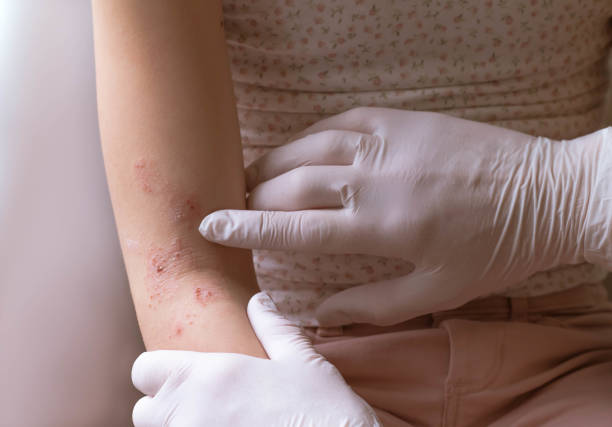 Can Eczema Treatment Treat Severe Cases