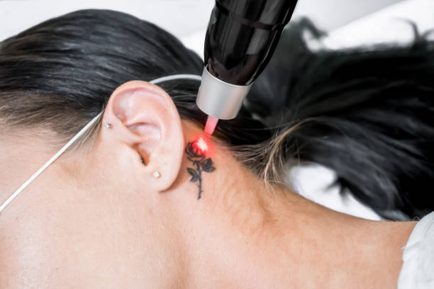 Can Laser Tattoo Removal Completely Erase Old Tattoos