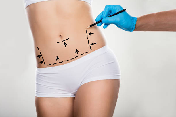 Can Liposuction Improve Overall Body Proportion