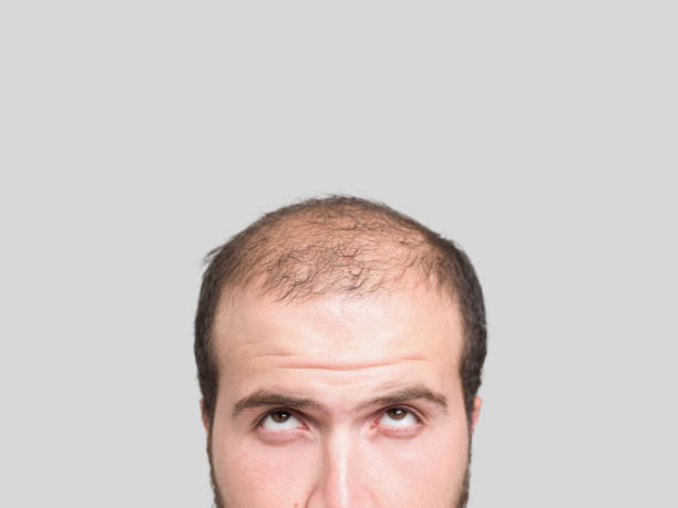 Does Hair Loss Treatment Work for Patchy Hair Loss