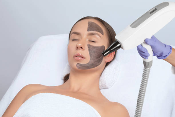 Does Laser Carbon Peel Even Skin Tone