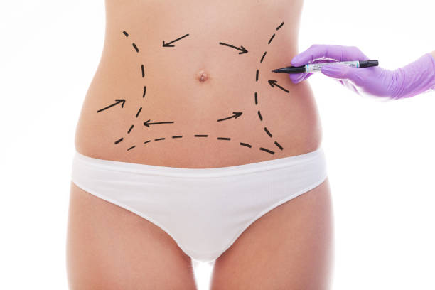 Does Lipo Abdominoplasty Improve Muscle Tone