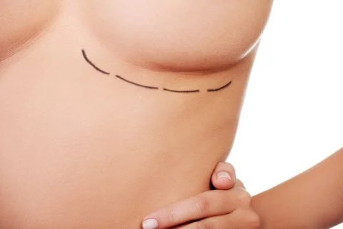Enhance Your Silhouette with Breast Implants