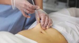 Fat Melting Injections A Gentle Approach to Fat Reduction