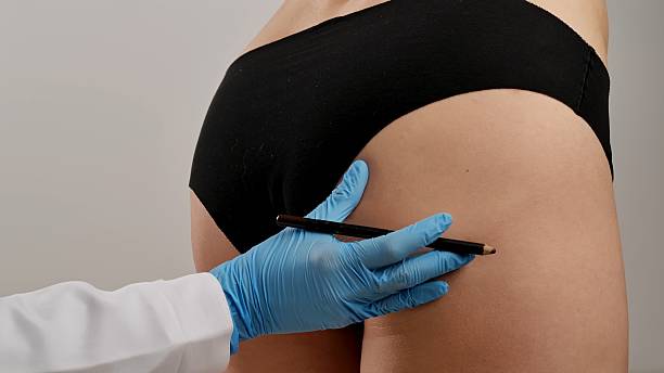 Get Leaner and More Defined with Vaser 4D Liposuction