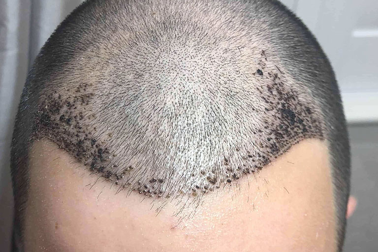 Get Natural Hair Growth with Hair Transplant