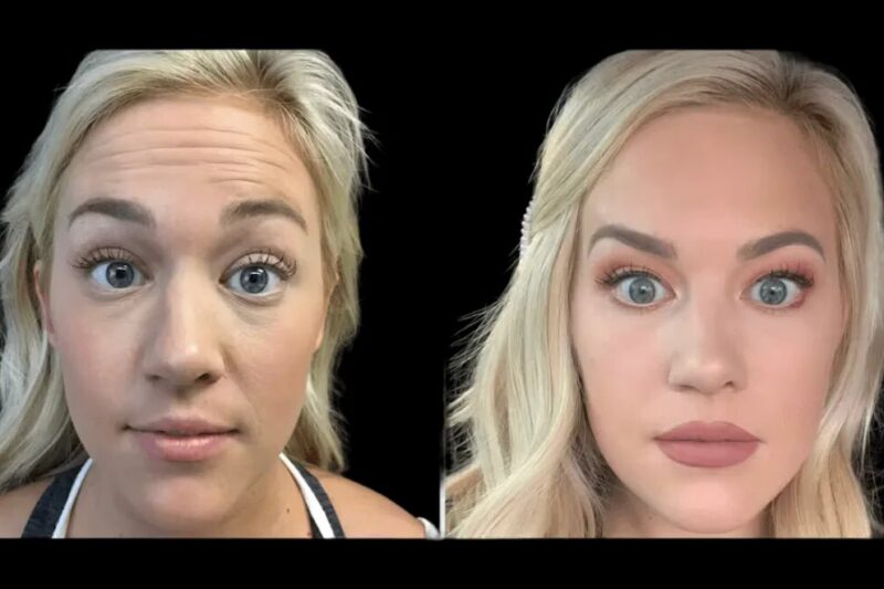 Combining Fillers and Botox at the Best Aesthetic Clinic in dubai for Natural Results