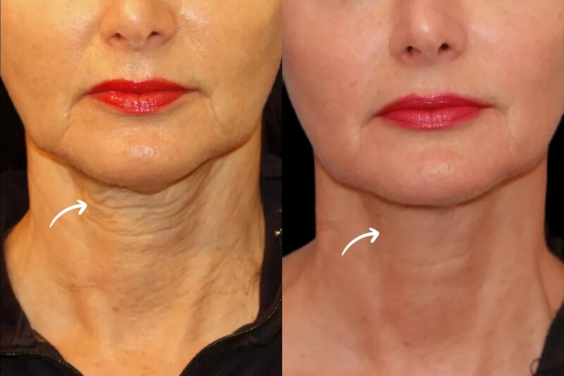 Best Plastic Surgeons in Dubai Reveal Sculptra Fillers Happiness Impact