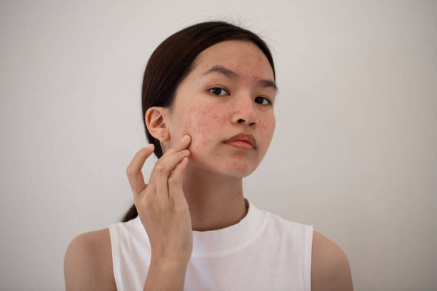 How Does Acne Treatment Improve Skin Texture