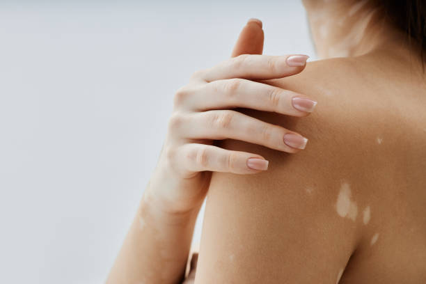 How Effective Is Vitiligo Treatment Today