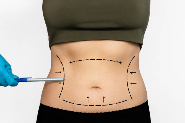 How Long Do Results from Liposuction Last