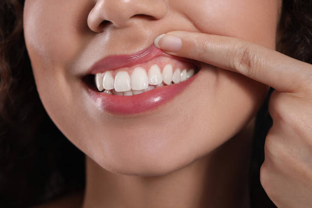 How Long Does Gum Recession Treatment Take