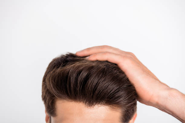 How Many Sessions Are Needed for Hair Transplant