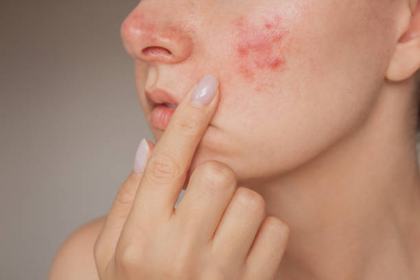 How Many Sessions of Laser Acne Scar Treatment Are Needed