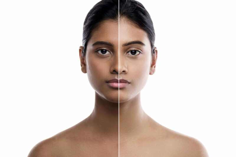 How Many Skin Whitening Treatment Sessions Needed?