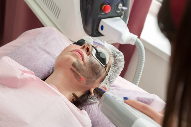 How Often Should You Get a Carbon Laser Facial Done