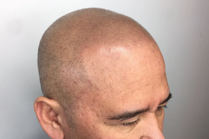 How Safe Is Modern Scalp Micropigmentation?