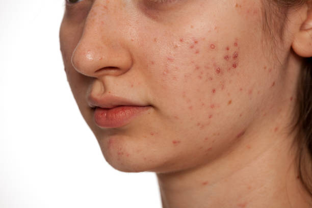 Is Acne Treatment Good for Hormonal Acne