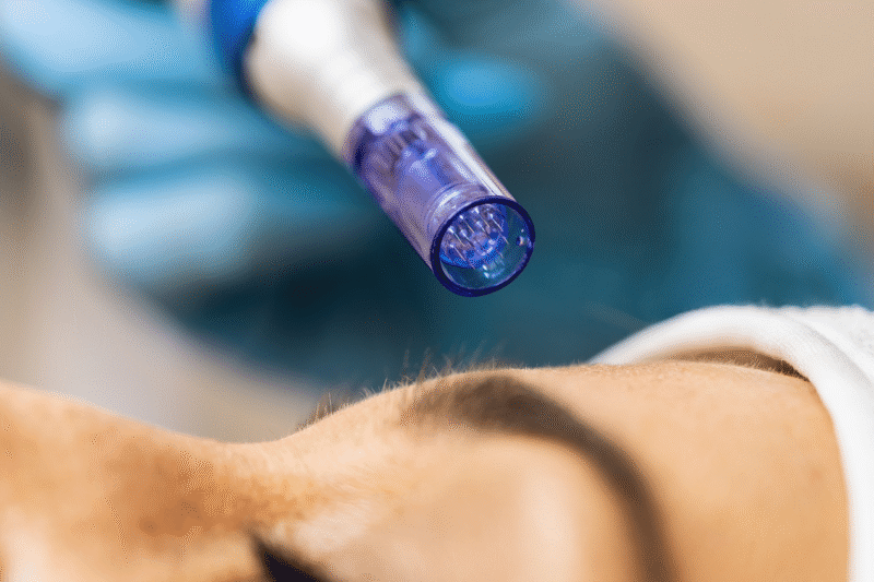 Is Dermapen Treatment Worth the Price?