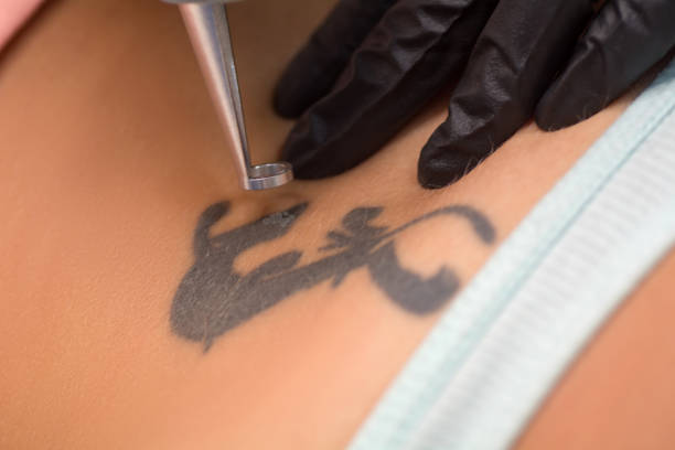 Is Laser Tattoo Removal Worth Trying