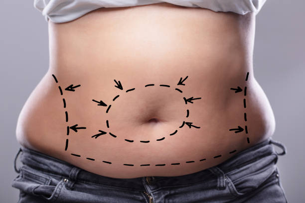 Is Liposuction Suitable for Weight Loss Goals