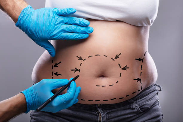 Is Mini Abdominoplasty a Good Option for Moms Post-Pregnancy