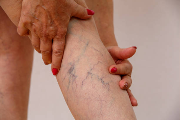 Is Sclerotherapy Suitable for Large Varicose Veins