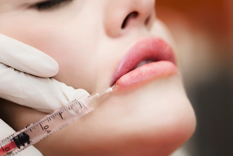 Lip Fillers for a Youthful Appearance
