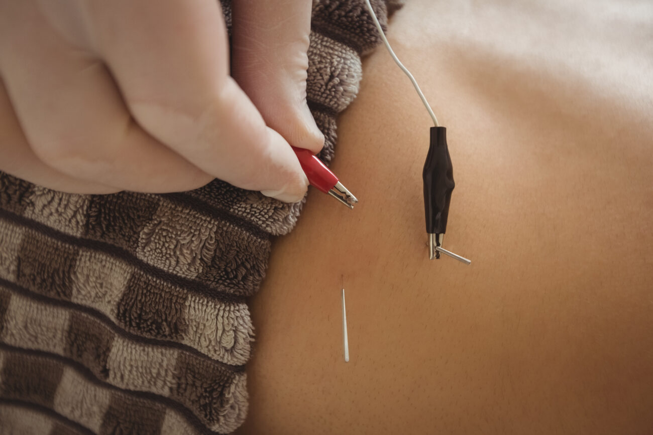 acupuncture for infertility